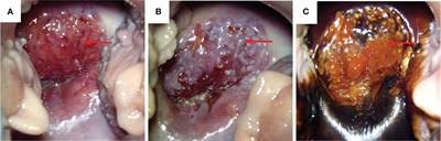 High-grade serous papillary ovarian carcinoma combined with nonkeratinizing squamous cell carcinoma of the cervix: a case report